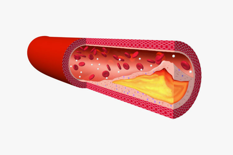 動脈硬化のイメージ画像